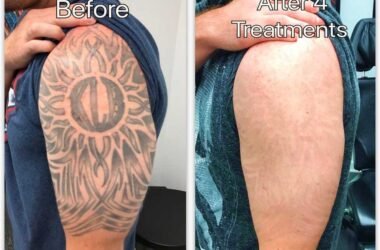 7 Reasons Why Divorce Tattoo Removal Can Be a Powerful Step Forward
