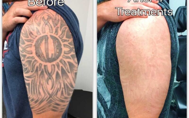 7 Reasons Why Divorce Tattoo Removal Can Be a Powerful Step Forward