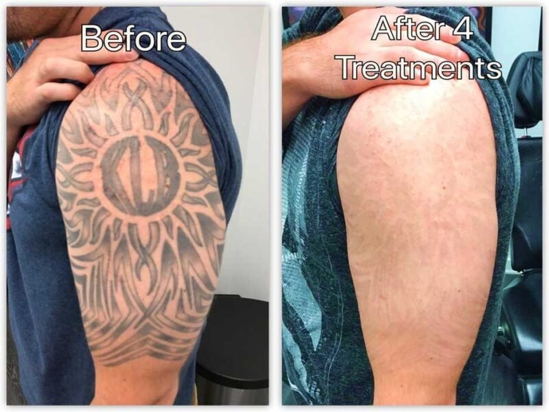 7 Reasons Why Divorce Tattoo Removal Can Be a Powerful Step Forward