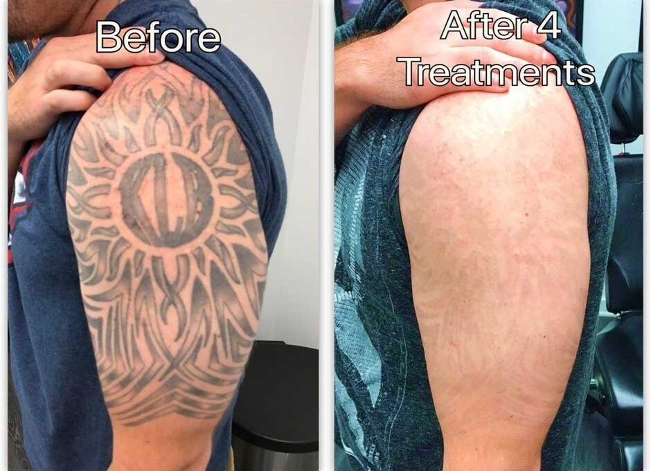 7 Reasons Why Divorce Tattoo Removal Can Be a Powerful Step Forward